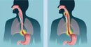 Yemek Borusunda Daralma Belirtileri ve Tedavisi