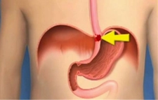 Yemek Borusu Ameliyatı Riskleri ve Sonrası