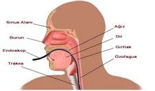 Yemek Borusu Reflüsü Belirtileri Nelerdir?