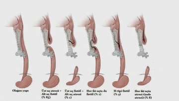 Bebeklerde Yemek Borusu Darlığı Belirtileri ve Tedavisi