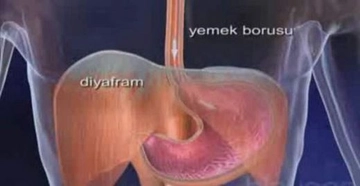 Mide Yemek Borusu Ağrısı Belirtileri ve Tedavisi