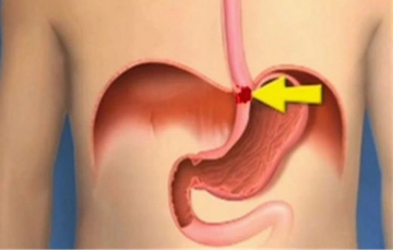 Yemek Borusu Tıkanıklığı Belirtileri ve Tedavisi